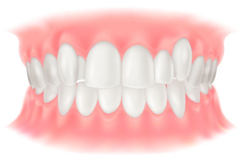 叢生(そうせい)
